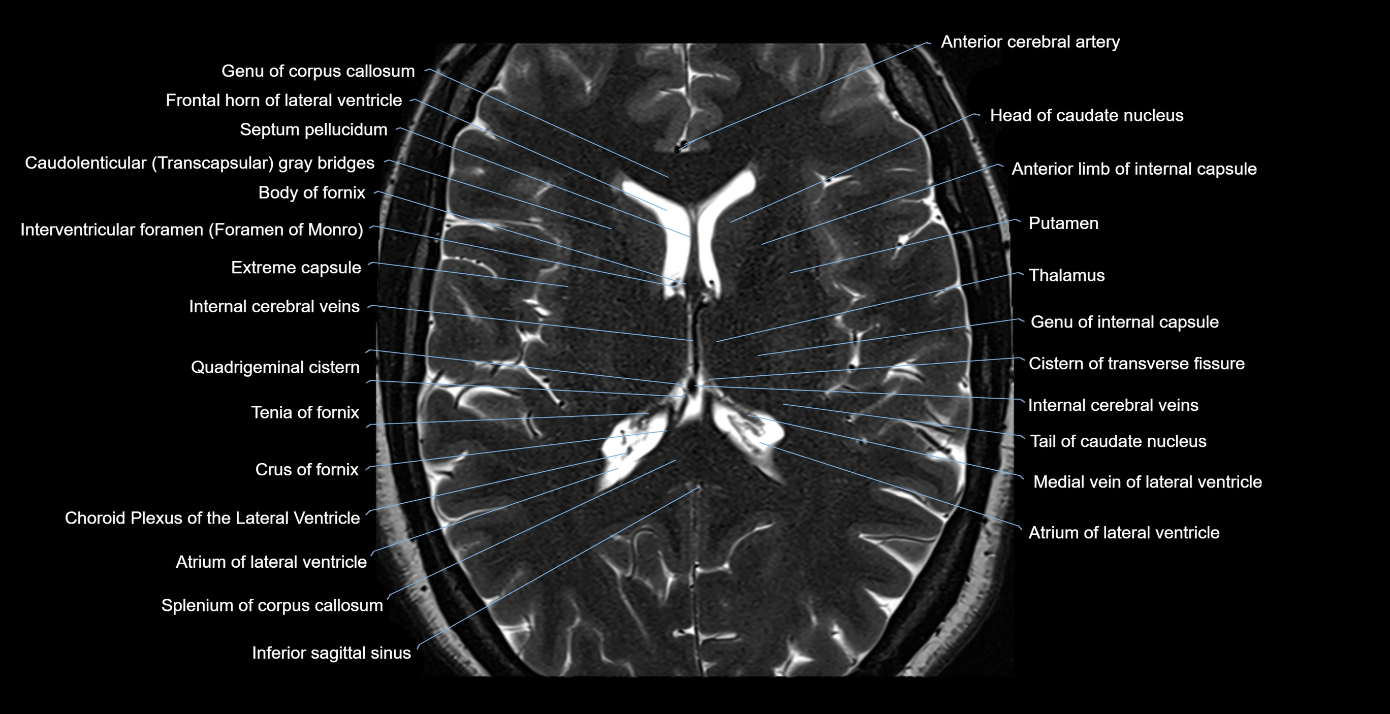 brain axial anatomy 3T MRI images -img-17001-00037.webp